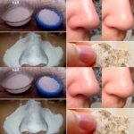 How to Remove Blackheads Naturally