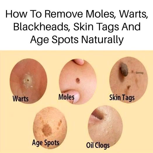 Natural Remedies for Age Spots Moles Skin Tags Warts and Blackheads