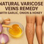 Natural Remedies to Reduce Varicose Veins