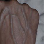 5 Health Conditions That Make Your Veins More Visible