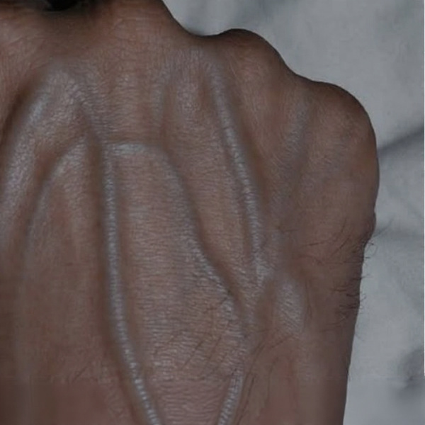 5 Health Conditions That Make Your Veins More Visible