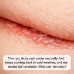 Rash Under Belly Fold: Causes, Treatment, and Prevention