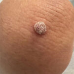 crusty bump on elbow