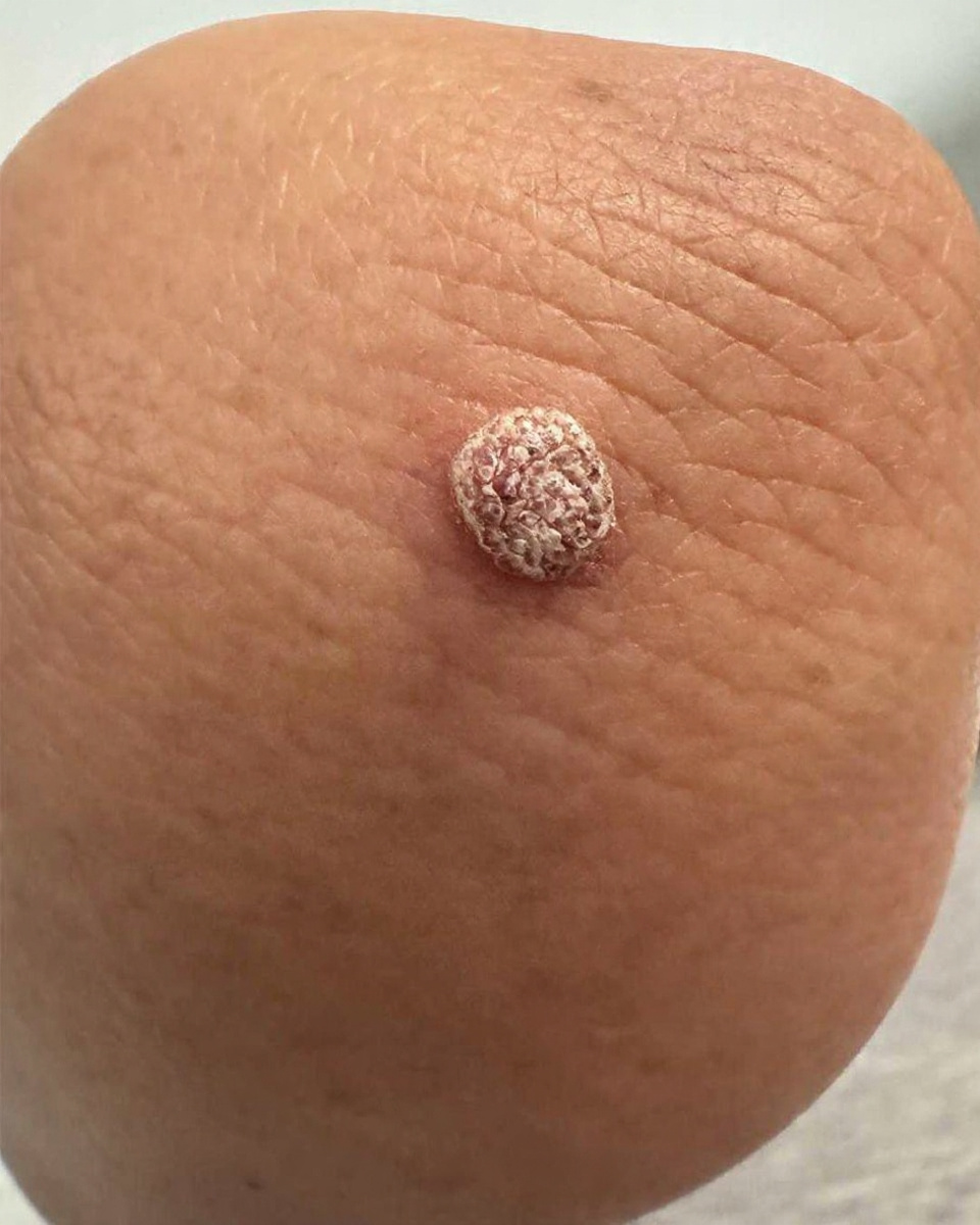 crusty bump on elbow